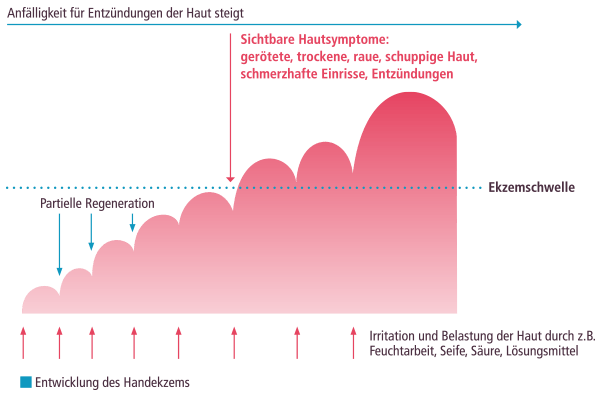 Handekzeme - Ursache, Symptome und Krankheitsverlauf